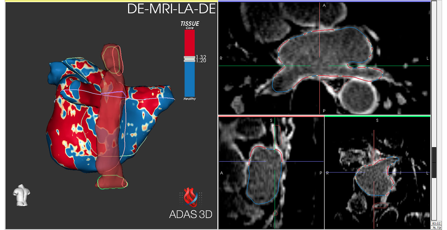 Media---LA_rotation-MRI